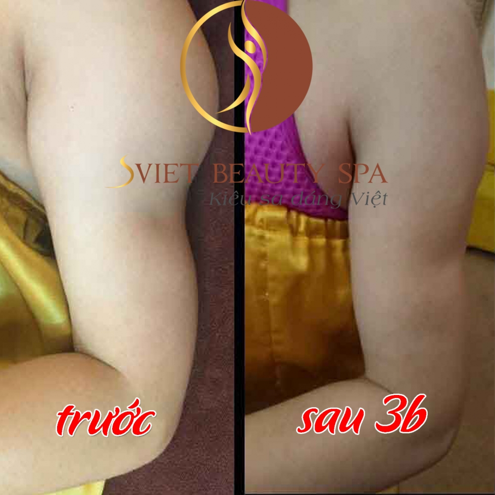 giảm béo bắp tay tại sviet 