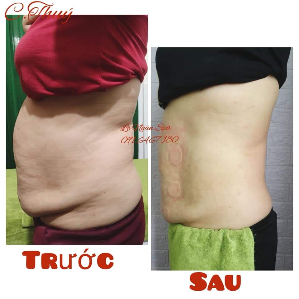 Dịch vụ giảm béo bụng tại Sviet Beauty Spa