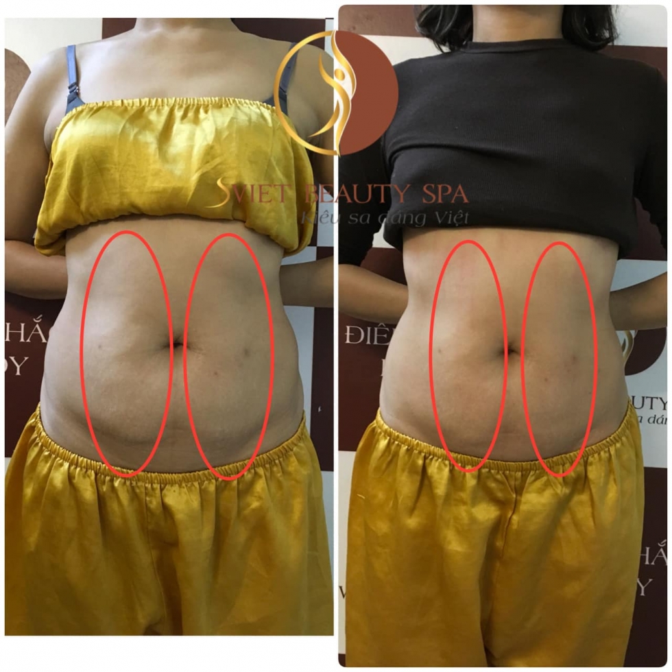 Dịch vụ giảm béo bụng tại Sviet Spa