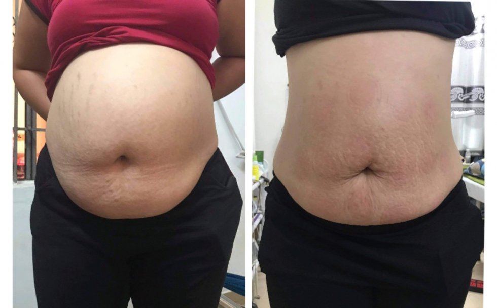 Cách giảm béo sau sinh cho bà bầu