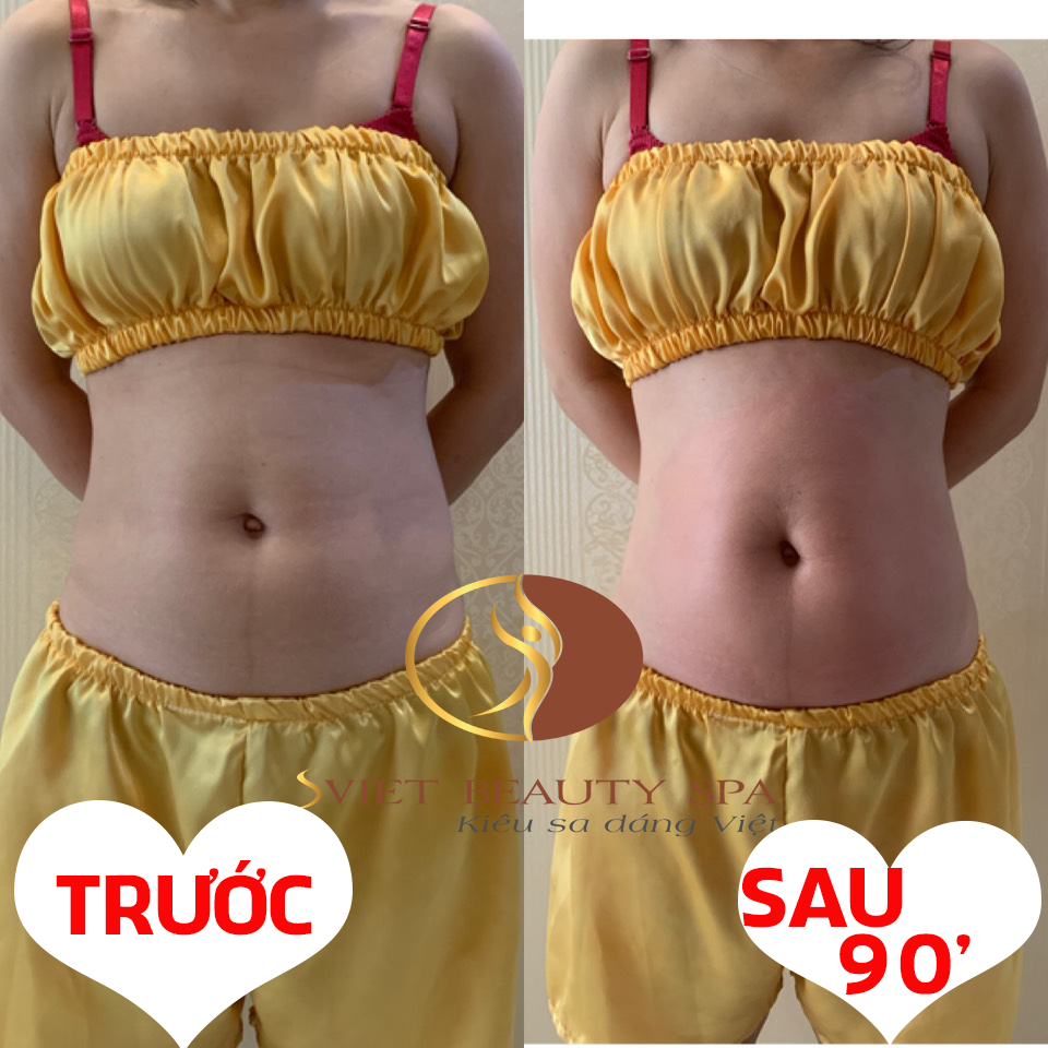 Dịch vụ giảm béo bụng tại Sviet Beauty Spa