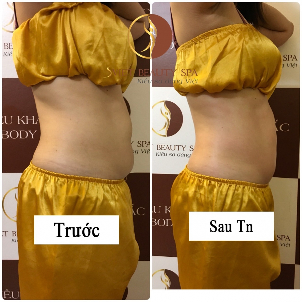 Dịch vụ giảm béo bụng tại Sviet Beauty Spa