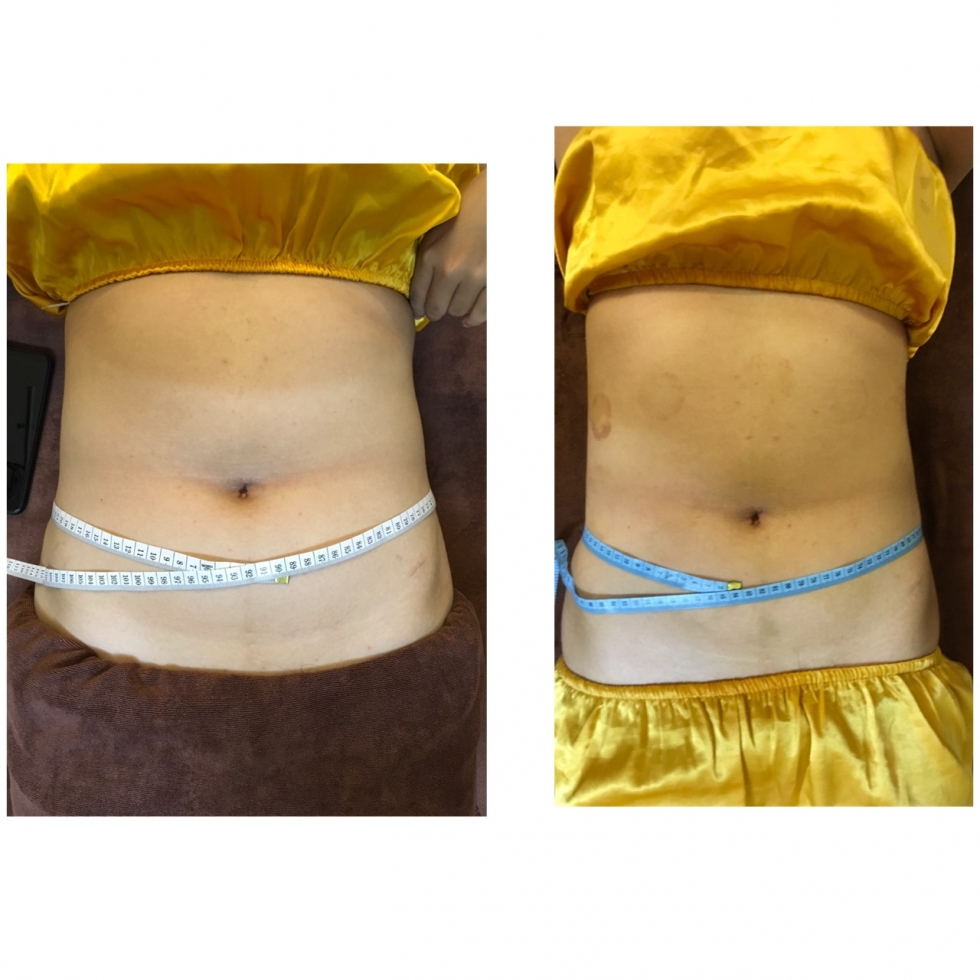 giảm béo eo, béo bụng tại sviet spa
