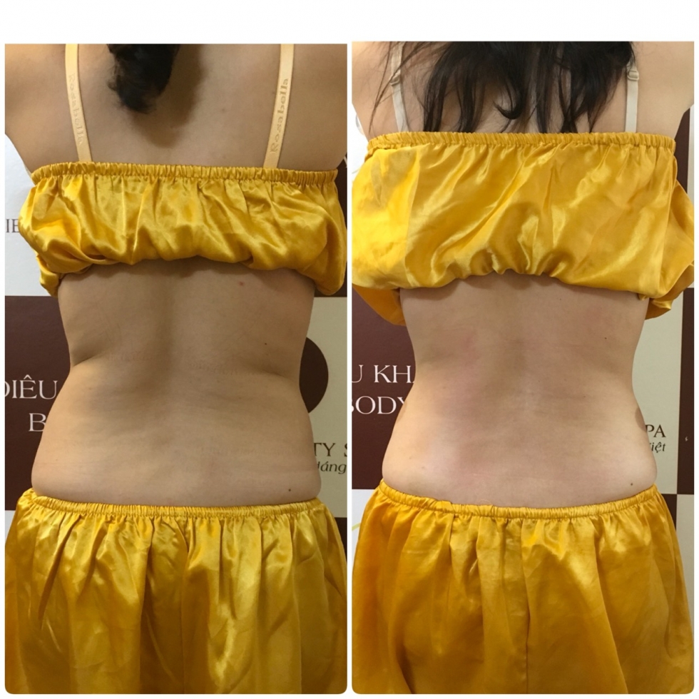 Giảm béo dưỡng sinh Nhật Bản có sự kết hợp hài hòa giữa massage bấm kết hợp phương pháp điêu khắc body tại Sviet Spa