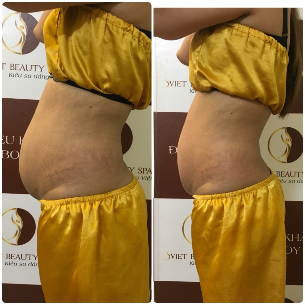 Hiệu quả của giảm béo dưỡng sinh kiểu nhật tại Sviet Spa