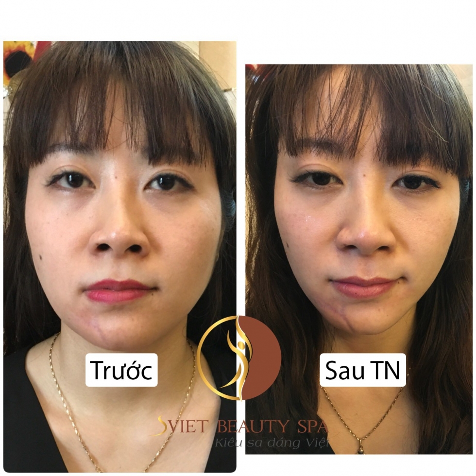 Công nghệ giảm béo mặt tại sviet beauty spa