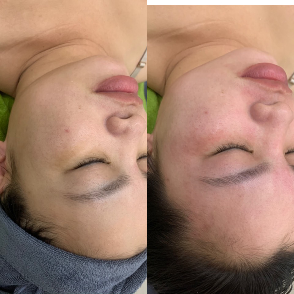 giảm béo mặt nhanh hiệu quả tại spa