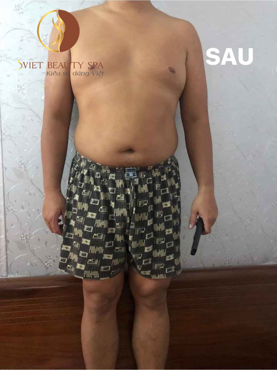 Quy trình giảm béo điêu khắc không xâm lấn tại SvietBeautySpa