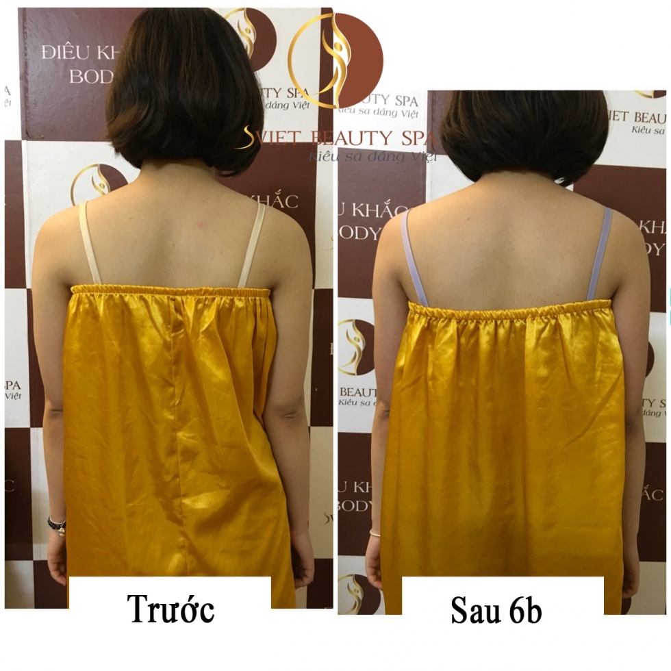 giảm béo vùng vai lưng hiệu quả sau liệu trình tại sviet