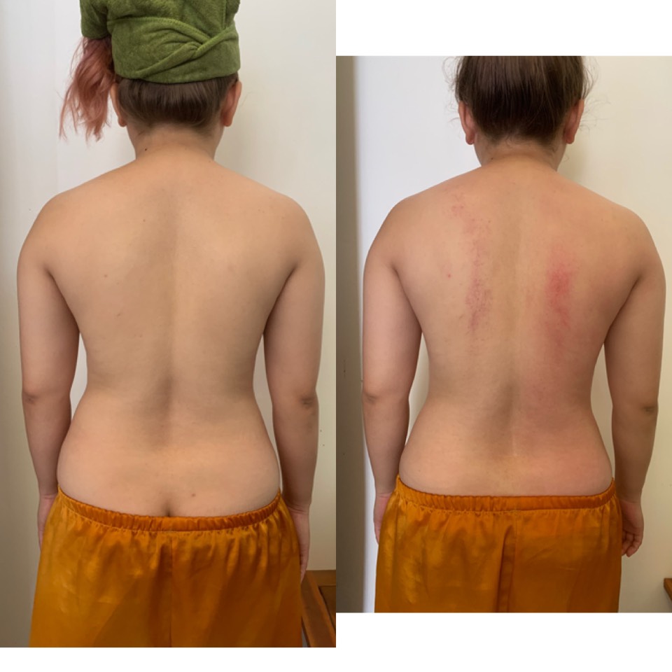 Giảm béo mông và đùi tại SvietBeautySpa
