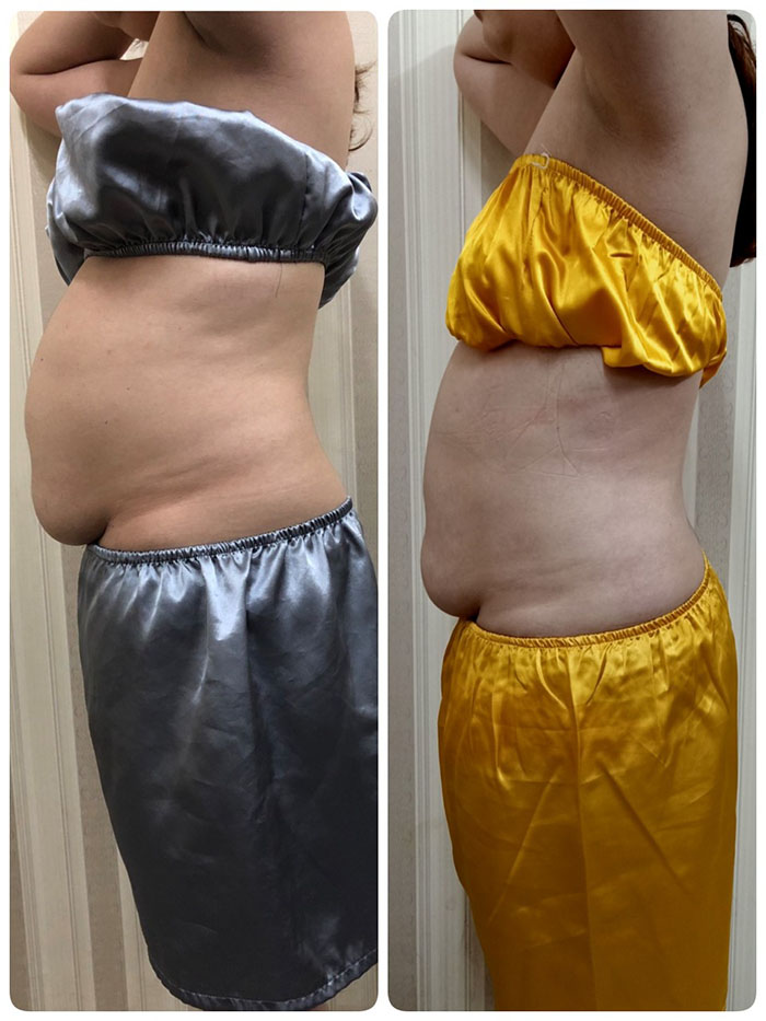 Kinh nghiệm giảm béo tại Sviet Spa