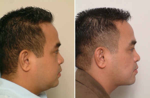 Phương pháp giảm béo mặt cấp tốc cho nam giới
