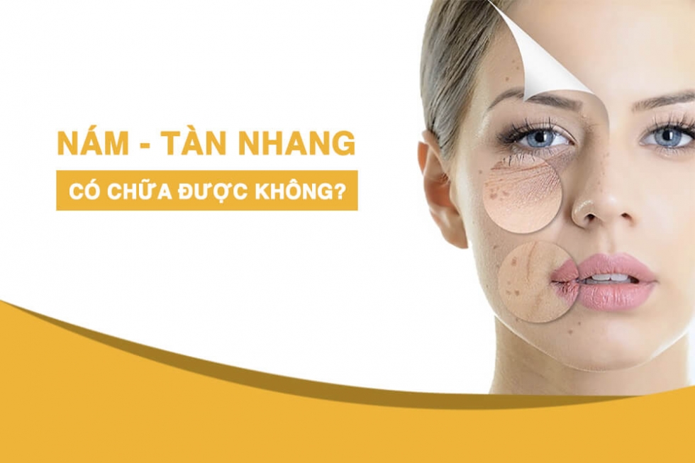 Nỗi lo lắng chung khi bị tàn nhang chị em
