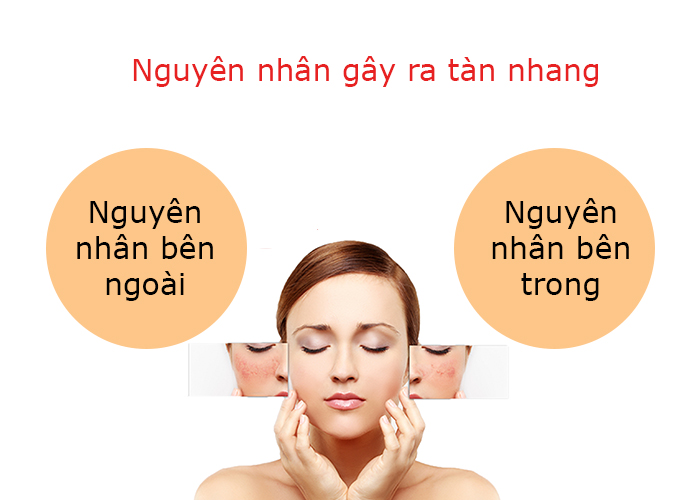Nguyên nhân gây tàn nhang
