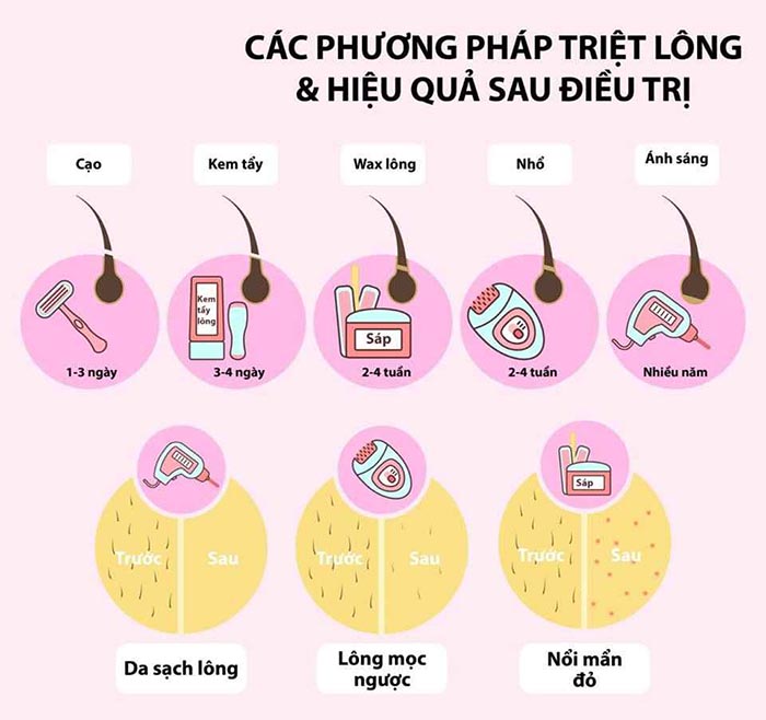 Phương pháp triệt lông phổ biến hiện nay