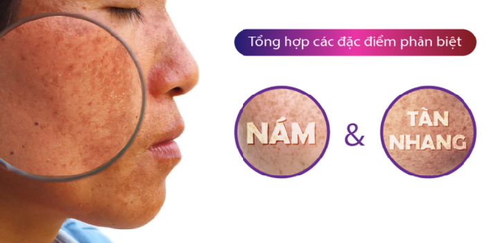 Tàn nhang và nám có giống nhau không