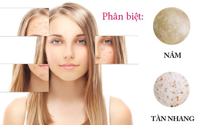Cách phân biệt nám và tàn nhang cách điều trị hiệu quả an toàn
