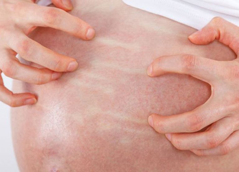 Cách trị ngứa rạn da khi mang thai an toàn cho mẹ và bé