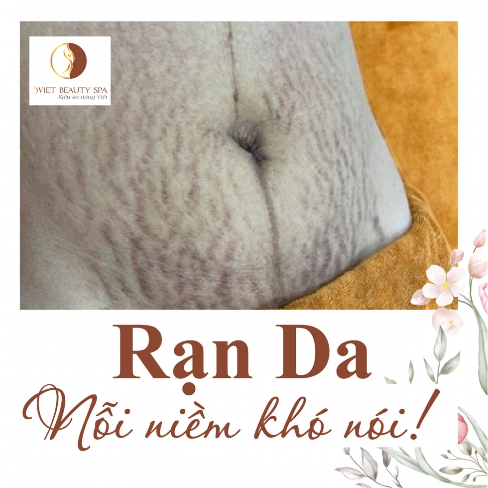 Điều trị rạn da bụng sau sinh phương pháp điều trị an toàn hiệu quả tại Svietspa