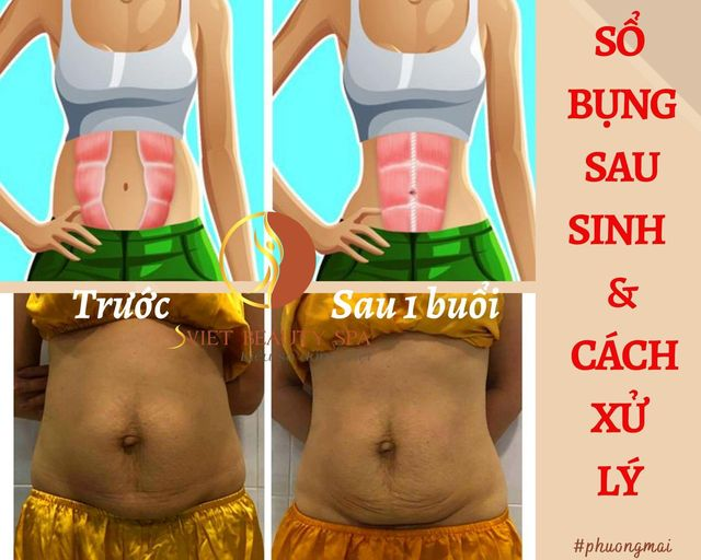sổ bụng sau sinh cách sử lý 