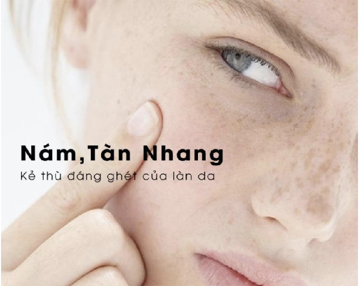 Bị tàn nhang không gây ảnh hưởng tới sức khỏe mà khiến làn da chị em mất thẩm mĩ