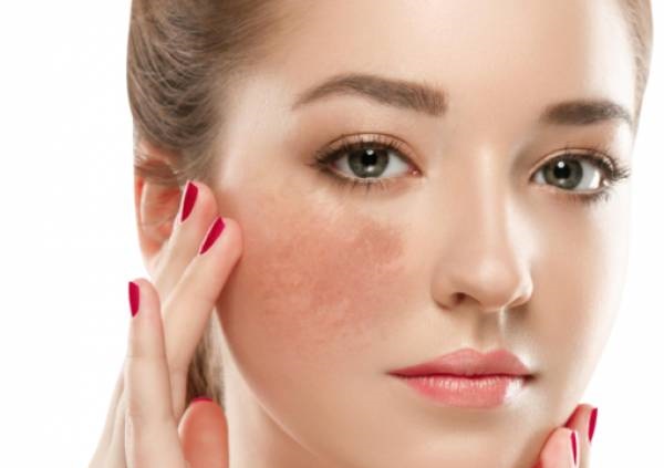 Tàn nhang xuất hiện như thế nào, điều trị tàn nhang có hết không ?