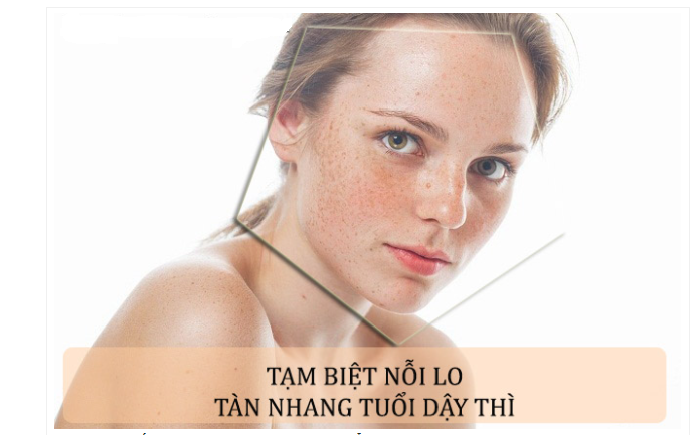 Phương pháp điều trị nàm tàn nhang tuổi dậy thì an toàn hiệu quả