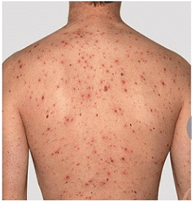 Triệt lông bị ngứa có thể gây ảnh hưởng đến sức khỏe và thẩm mỹ cơ thể