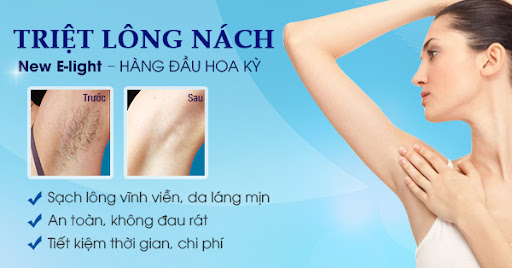 Triệt lông công nghệ an toàn hiệu quả tại Svietspa