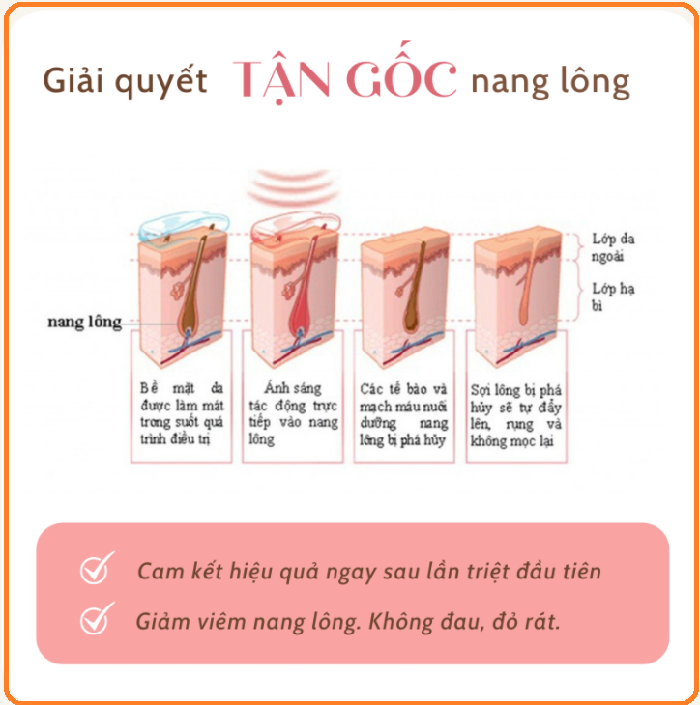 Triệt lông giải pháp hiệu quả giúp chị em đánh bay những vùng lông không mong muốn