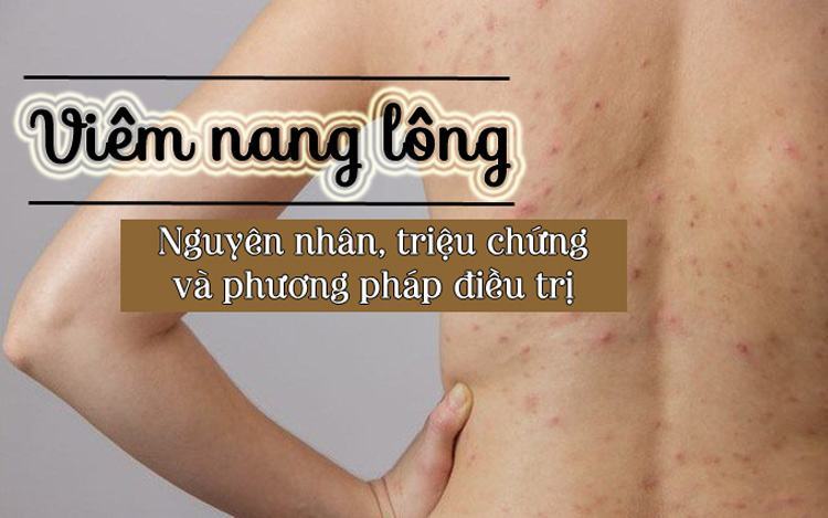 Viêm nang lông