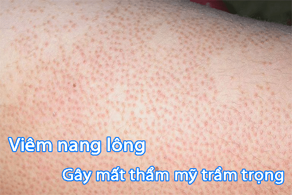 Viêm nang lông nguyên nhân và cách điều trị
