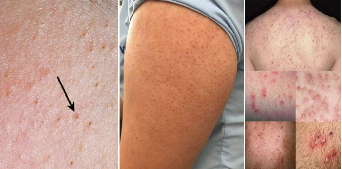 Viêm nang lông và cách điều trị hiệu quả