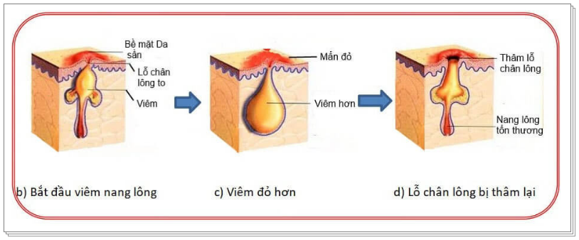 Tình trạng dấu hiệu bị viêm nang lông
